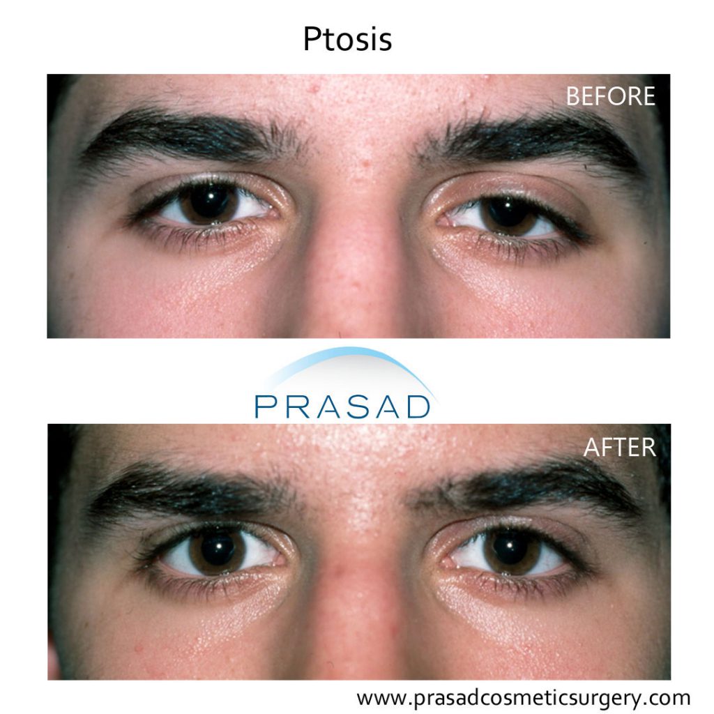 droopy eyelid treatment - male ptosis repair before and after