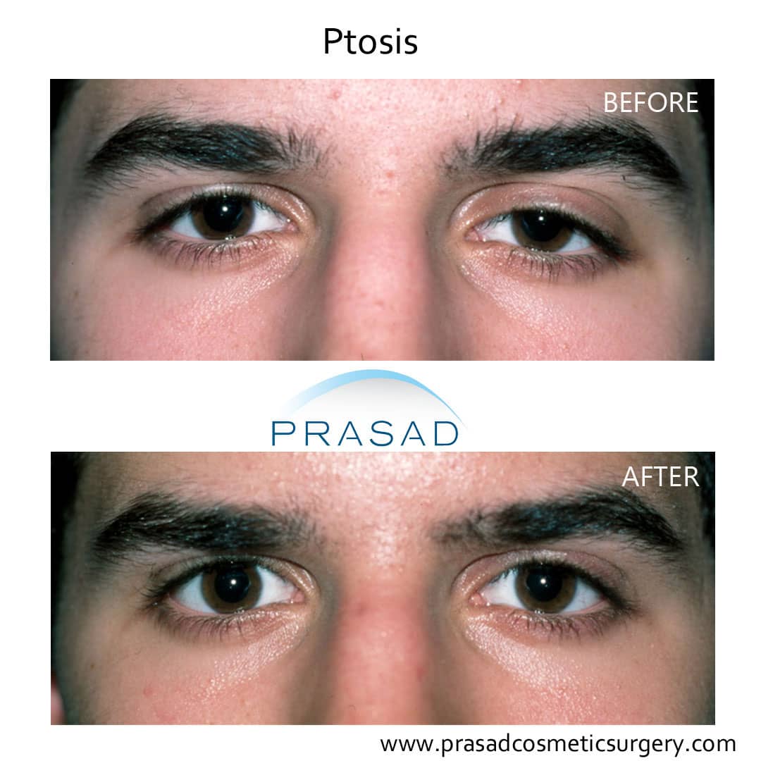 male ptosis repair before and after