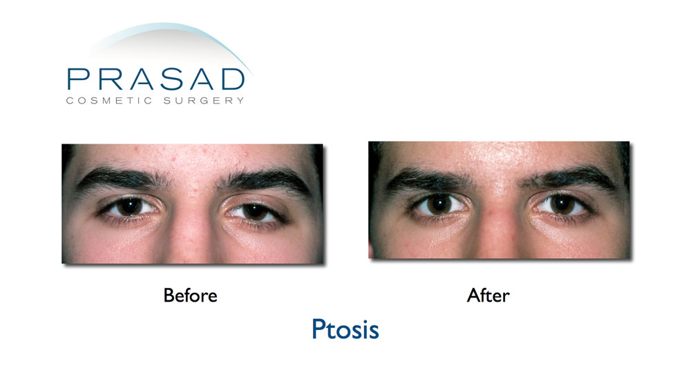 ptosis correction surgery before and after