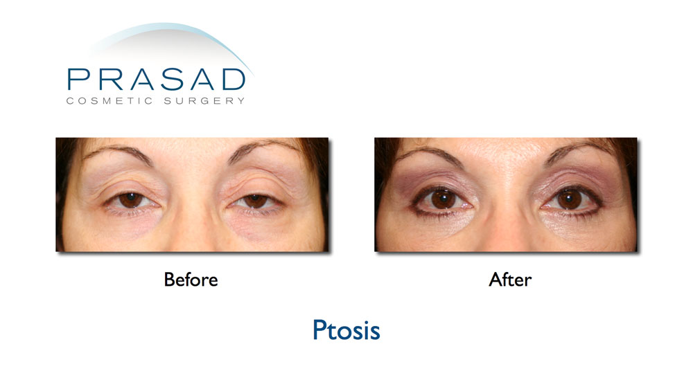 drooping eyelid surgery before and after