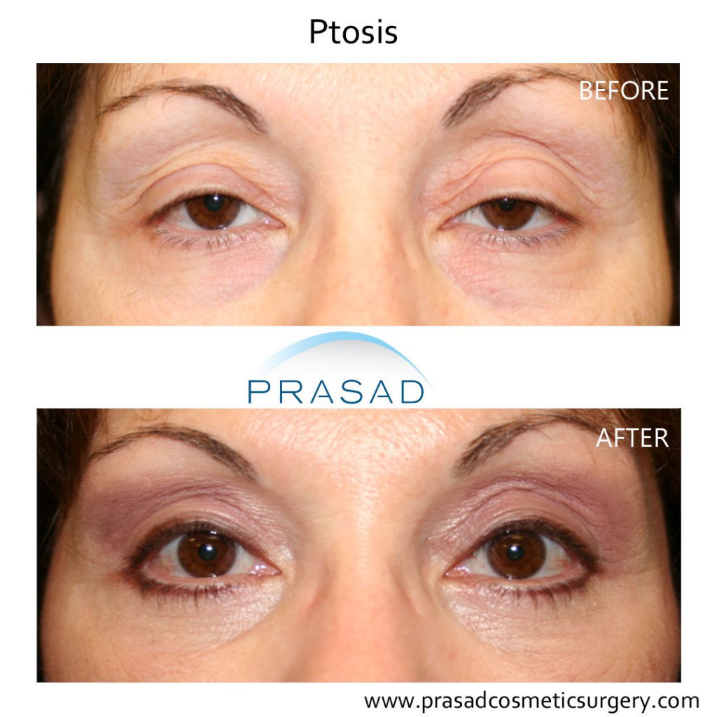 female eyelid ptosis surgery before and after