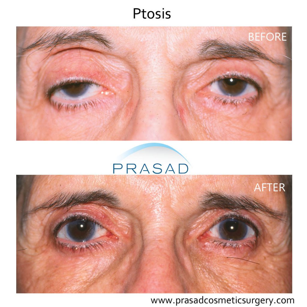ptosis surgery before and after old age