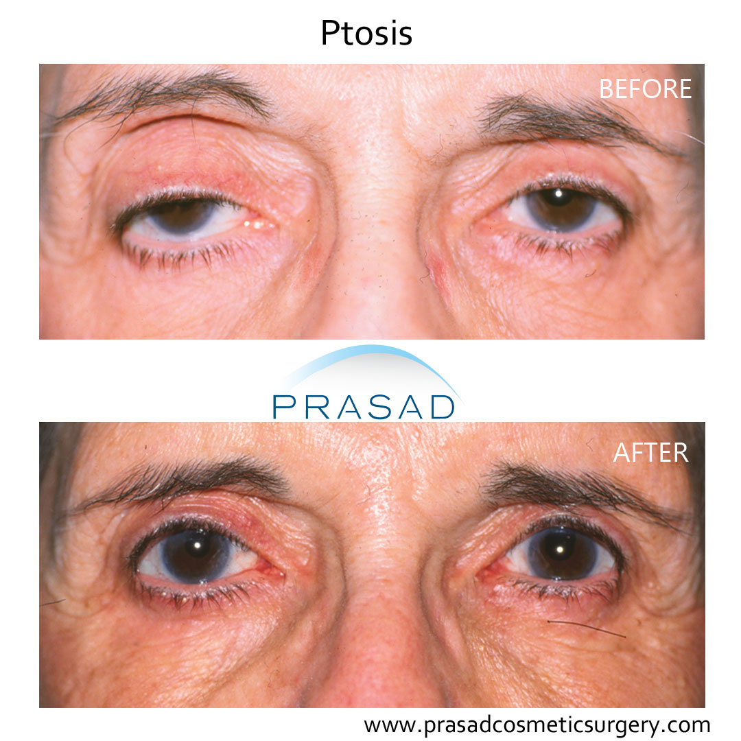 Ptosis Surgery Before And After Photos Amiya Prasad Md Facs