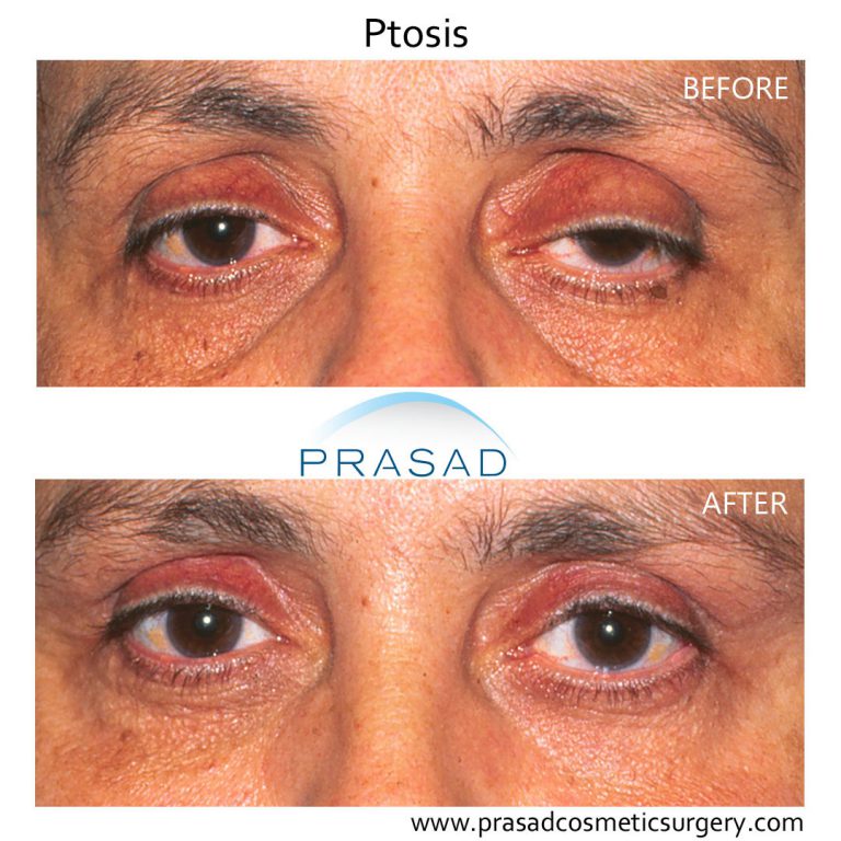 eyelid ptosis surgery before and after