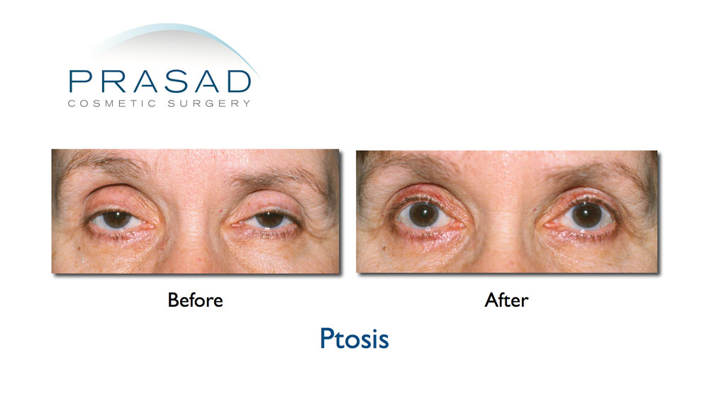 Ptosis repair before and after surgery of older female patient