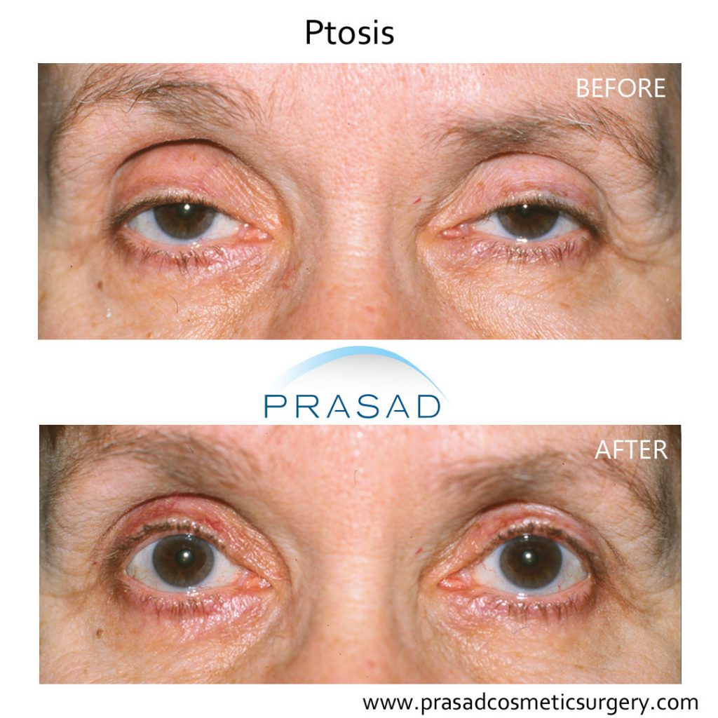 before and after Ptosis surgery recovery of adult female patient