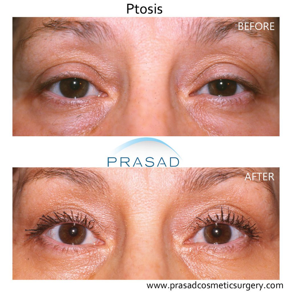 droopy eyelid surgery before and after
