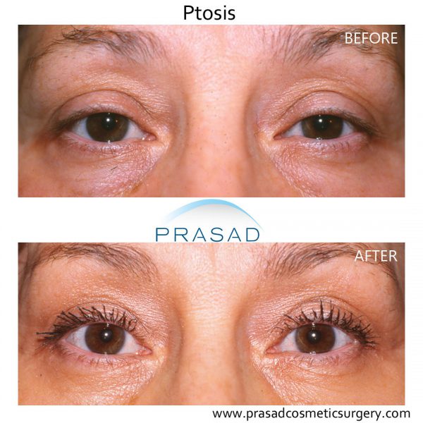 Droopy Eyelid Surgery Eyelid Ptosis Procedure And Recovery 