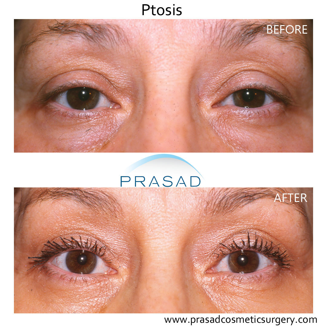 female ptosis surgery before and after