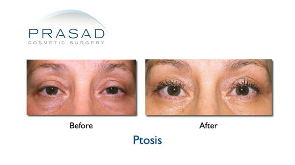 Droopy Eyelid Surgery: Eyelid Ptosis Procedure, and Recovery