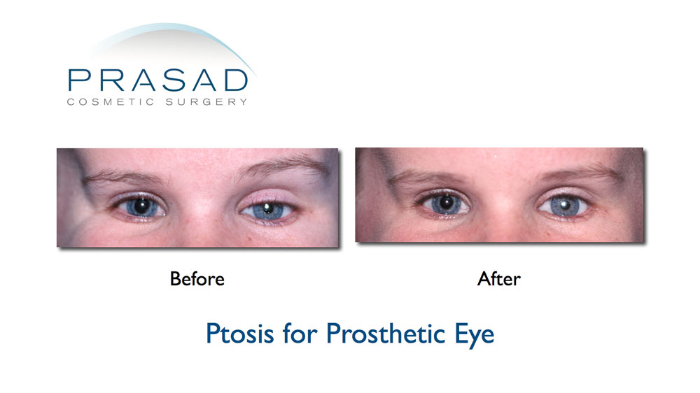 ptosis surgery before and after child