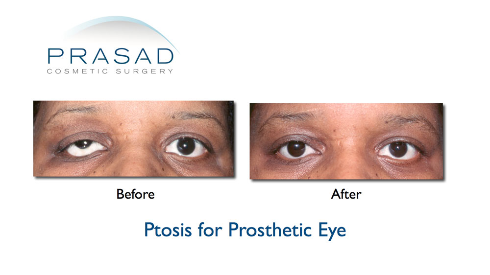 ptosis surgery for prosthetic eye before and after