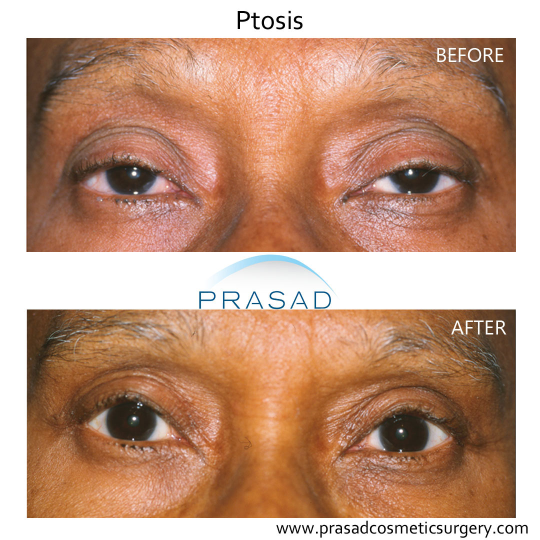 ptosis surgery before and after