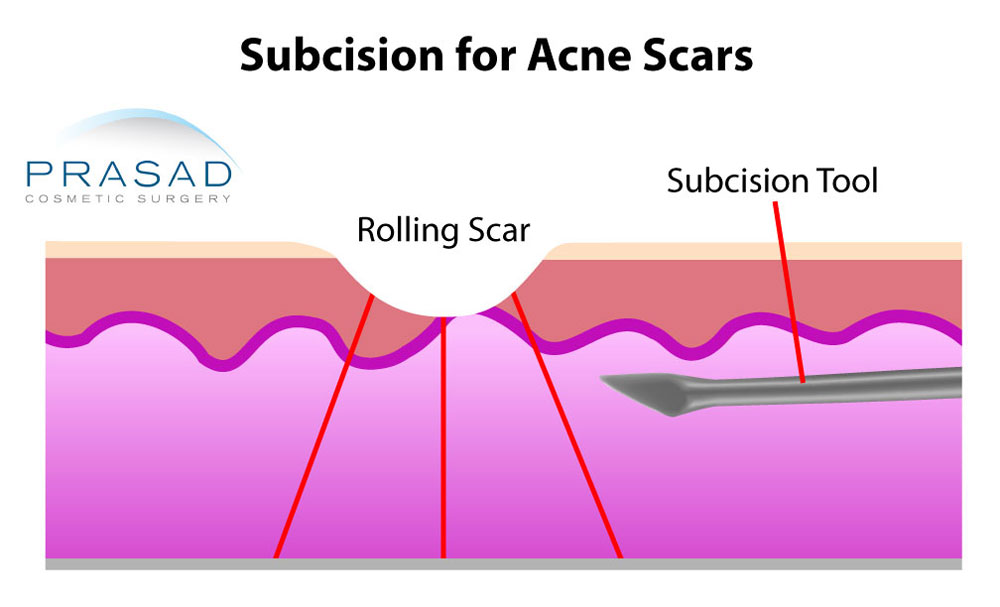 subcision procedure for acne scars illustration