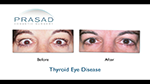 thyroid eye disease before and after