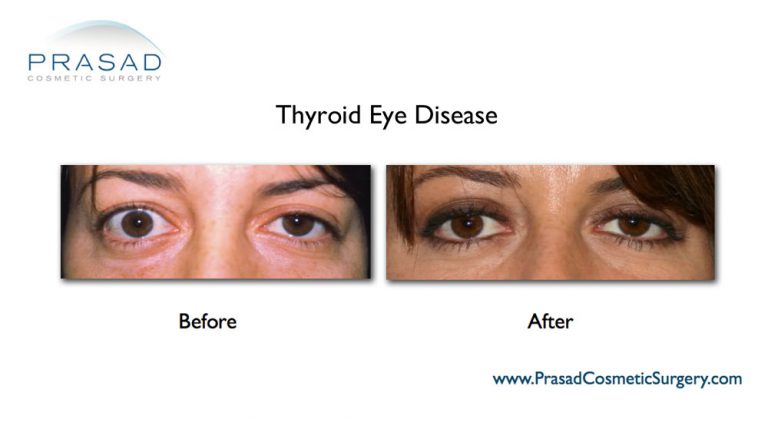 Thyroid Eye Disease Surgery/ Graves Eye Disease Surgery