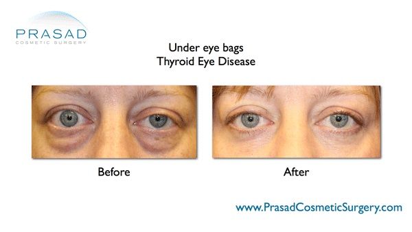 eye bag removal before and after
