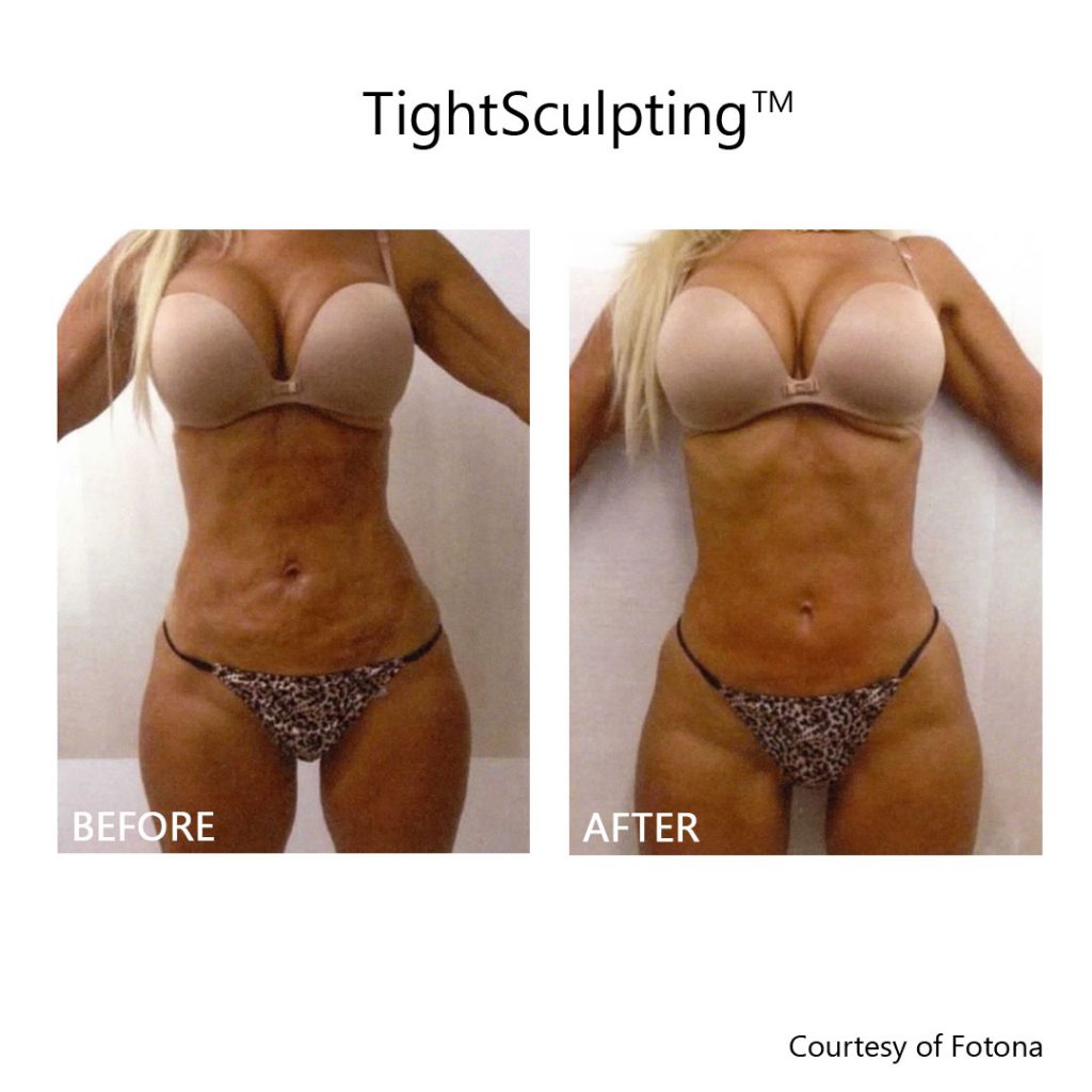 Laser skin tightening before and after results