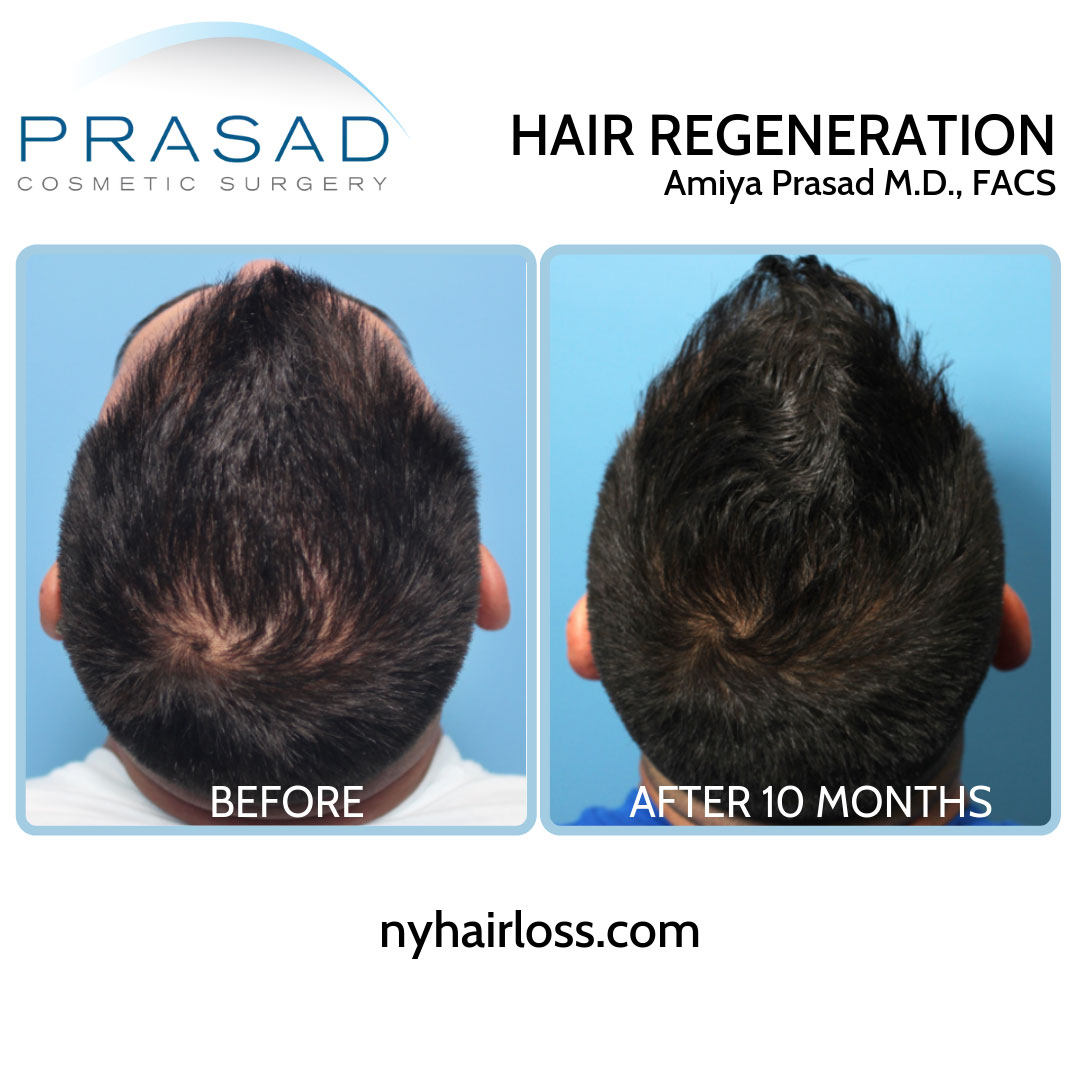 TrichoStem Hair Regeneration before and after 10 months top of scalp view