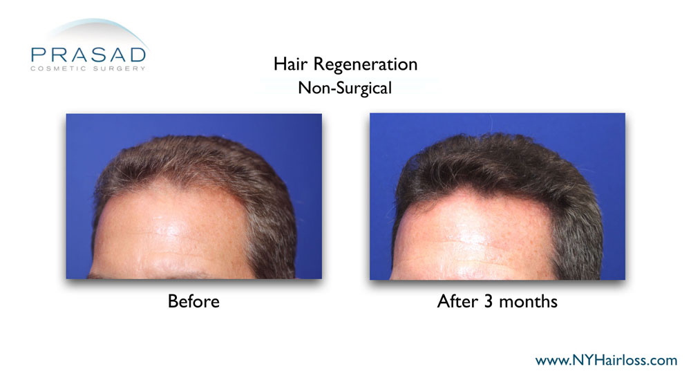TrichoStem Hair Regeneration before and after 3 months left temple performed by Amiya Prasad MD