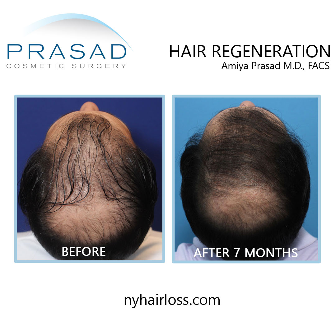 before and after hair loss treatment for men