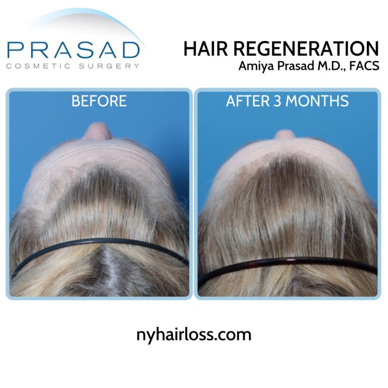 TrichoStem Hair Regeneration female pattern hair loss top of the head view before and after 3 months