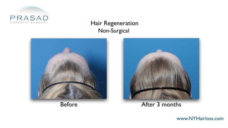 TrichoStem Hair Regeneration female pattern hair loss top of the head view before and after 3 months