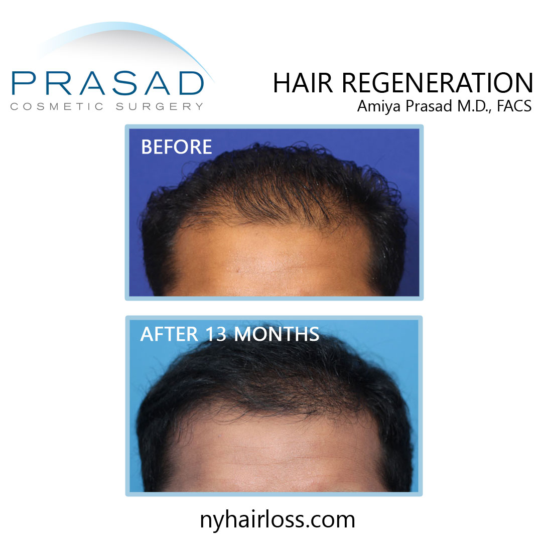 before and after male hair loss treatment, Procedure performed by Dr. Amiya Prasad Manhattan NYC