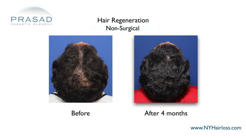 TrichoStem Hair Regeneration top of the head view before and after 4 months