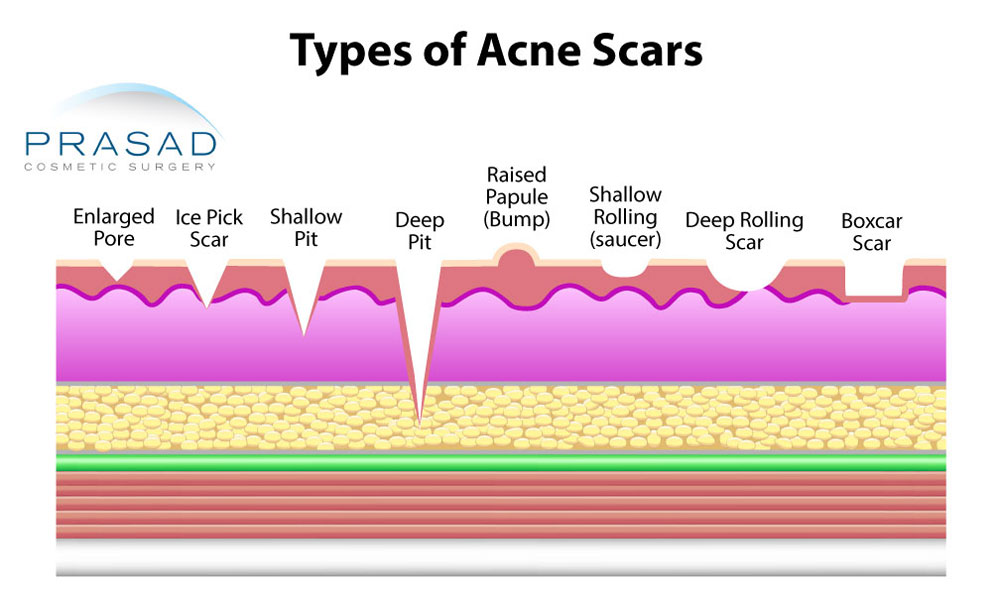 types of acne scars illustration