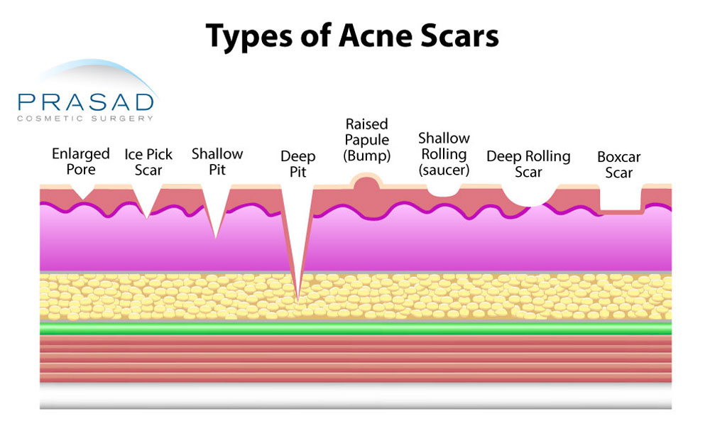 how to get rid of boxcar acne scars