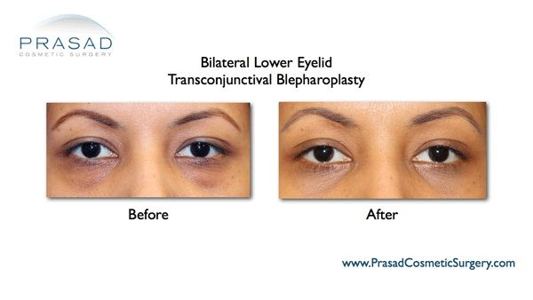eye bag removal before and after performed by Dr. Amiya Prasad NYC