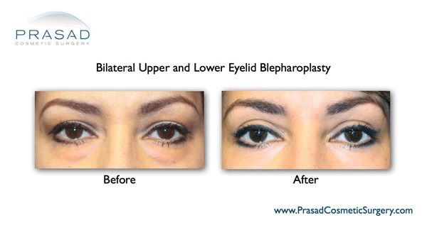 upper and lower blepharoplasty before and after