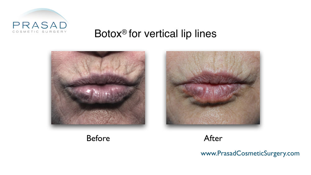 botox for lip lines before and after