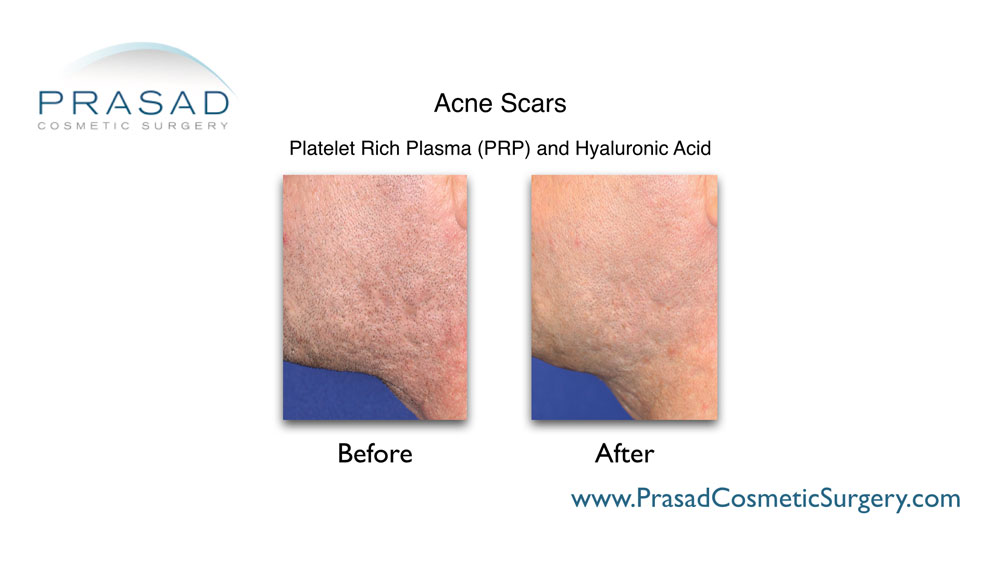 acne scars PRP treatment before and after, procedure done at Prasad Cosmetic Surgery NYC