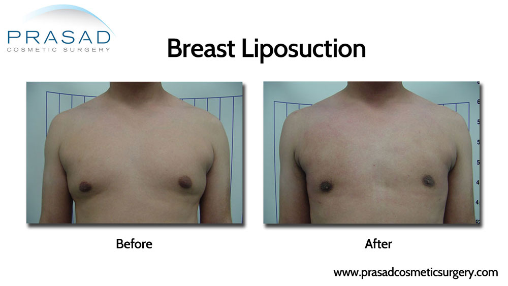 breast liposuction before and after