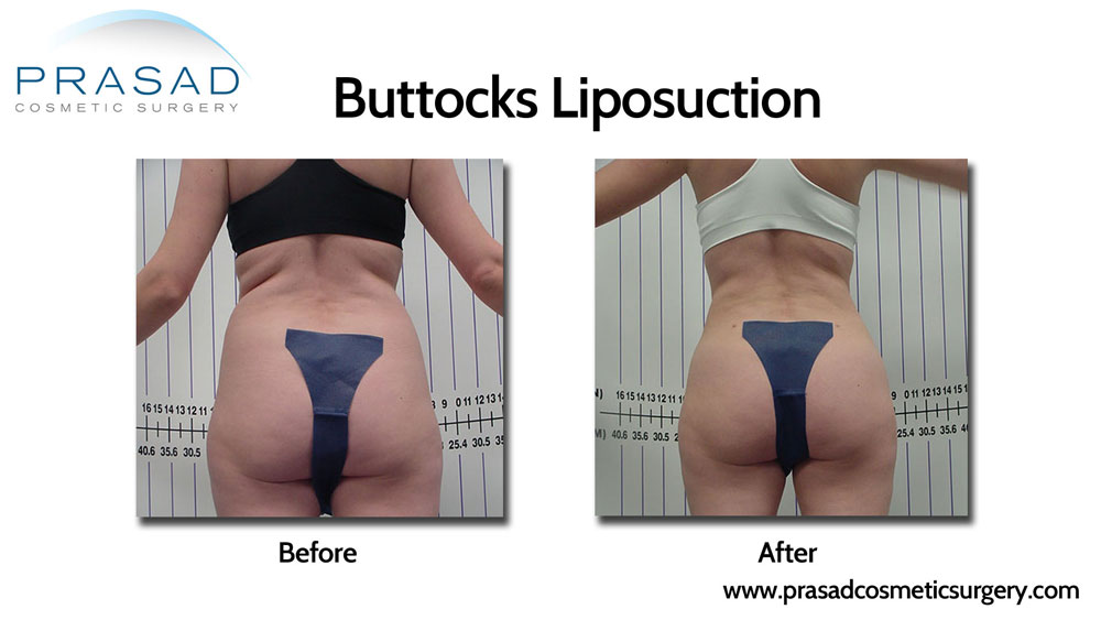 buttocks liposuction before and after