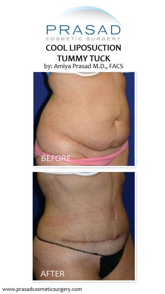 liposuction tummy before and after