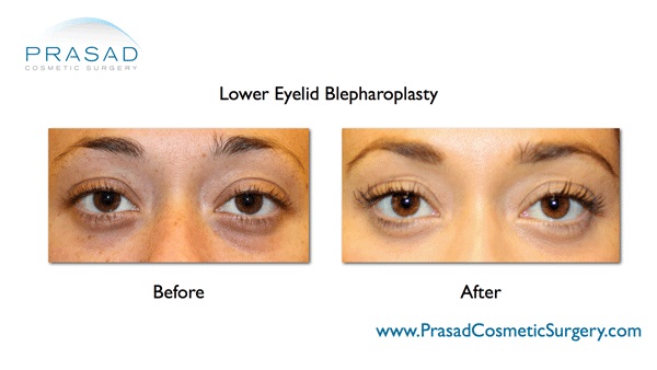 lower eyelid surgery before and after