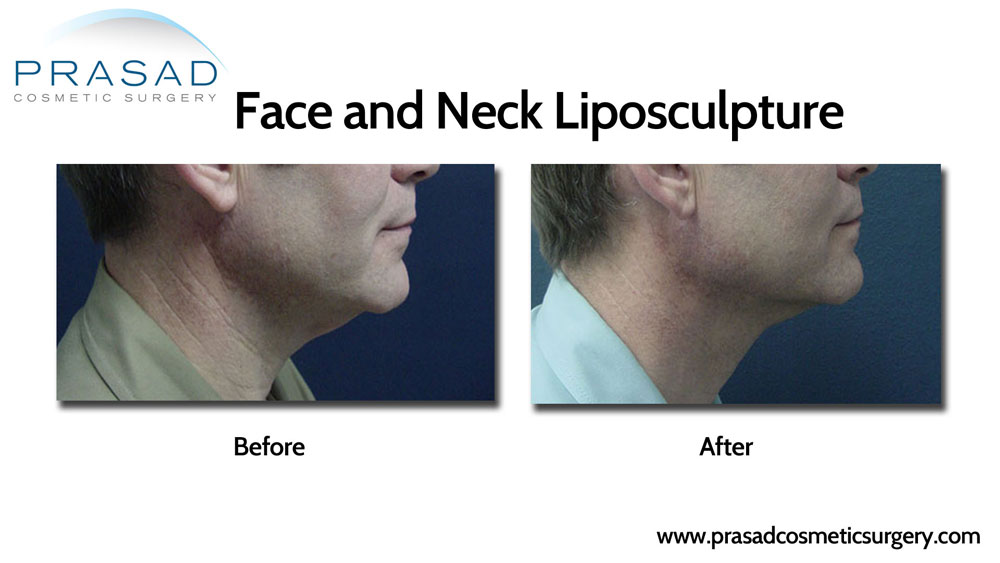 before and after face and neck liposuction performed by Dr. Amiya Prasad