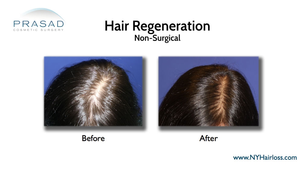 hair loss treatment for female before and after