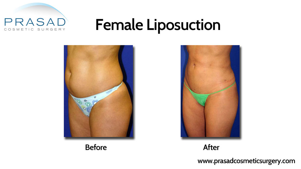 female liposuction before and after