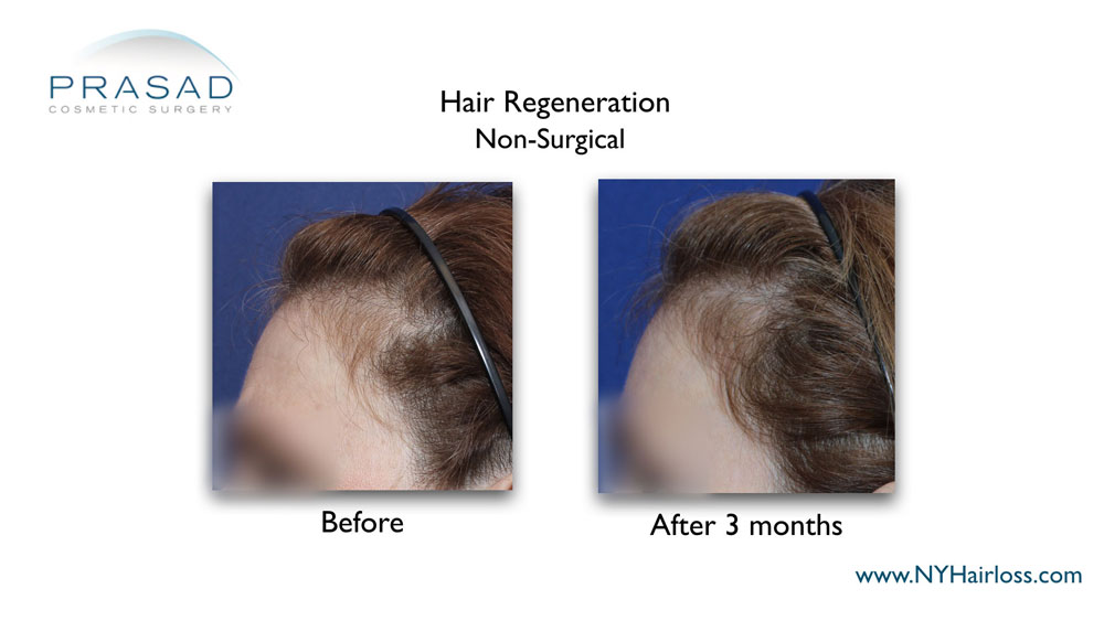 Best hair loss treatment for female before and after