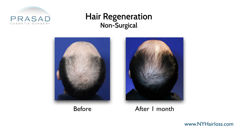 non surgical hair loss treatment before and after 1 month
