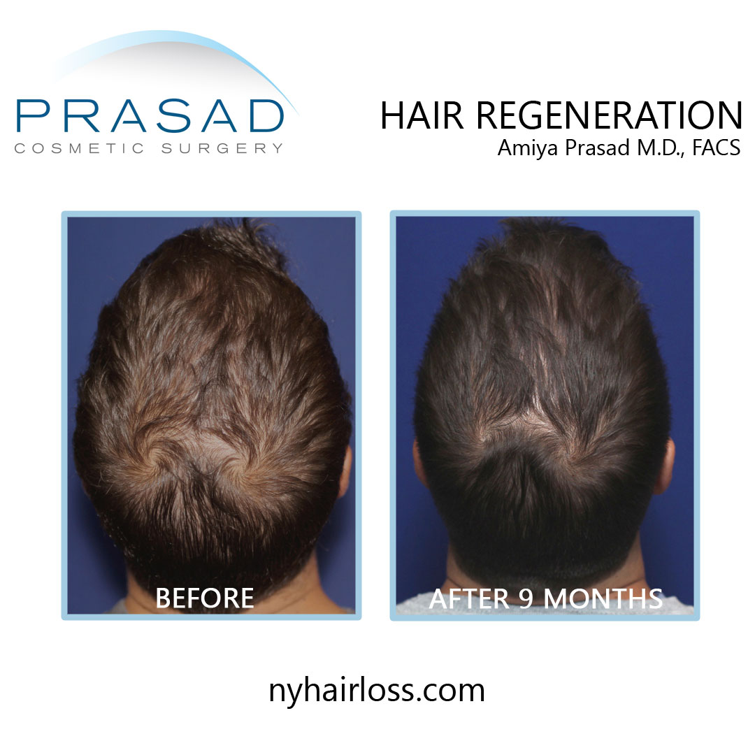 Best hair loss treatment for men before and after