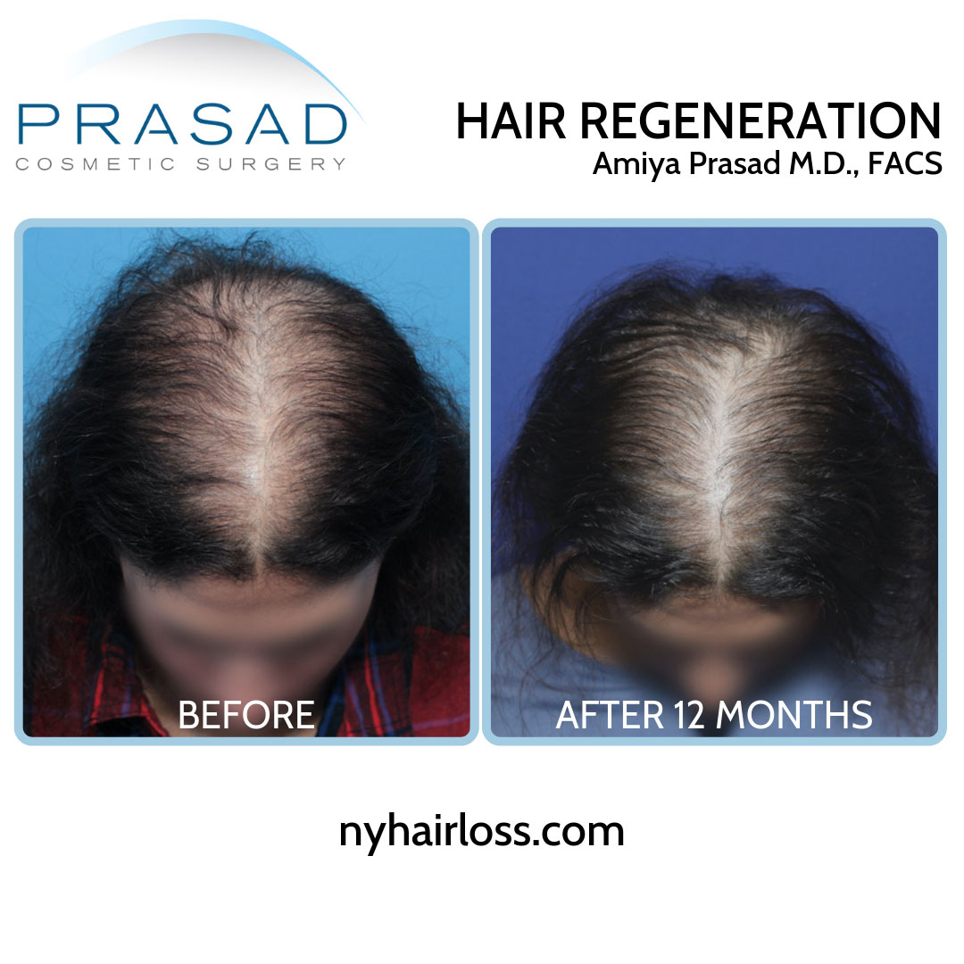 female pattern baldness in 20s treatment before and after