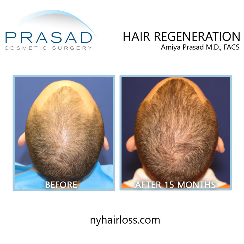 hair regeneration before and after treatment top of the head view