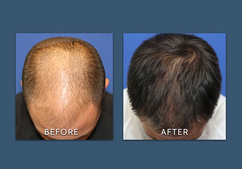 hair restoration before and after