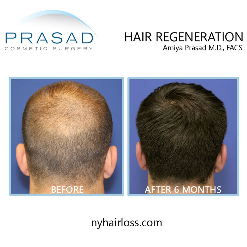 before and after hair transplant alternative treatment