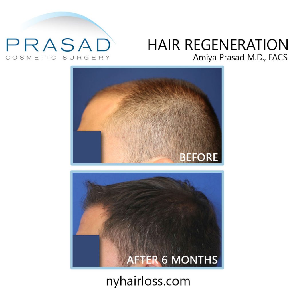 before and after hair loss treatment for men